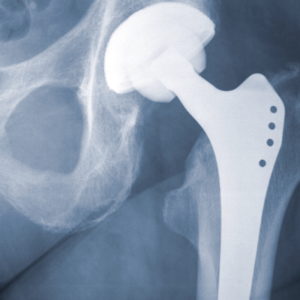 X-ray of an artificial left hip joint of a large human